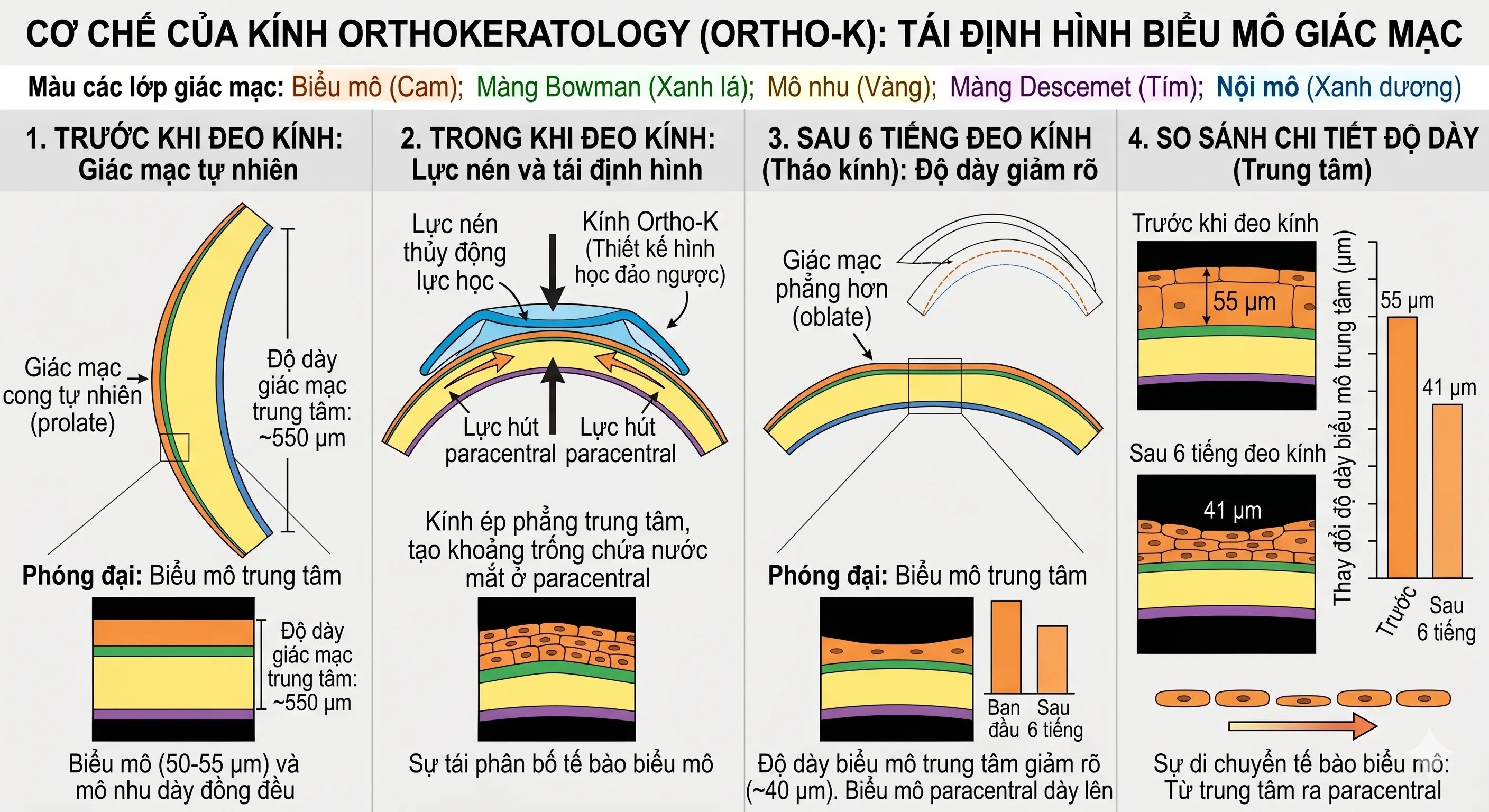 Cơ chế kỹ thuật Ortho-K — tái định hình biểu mô giác mạc